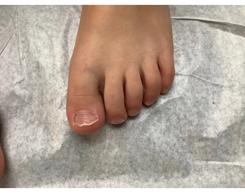 Post-treatment