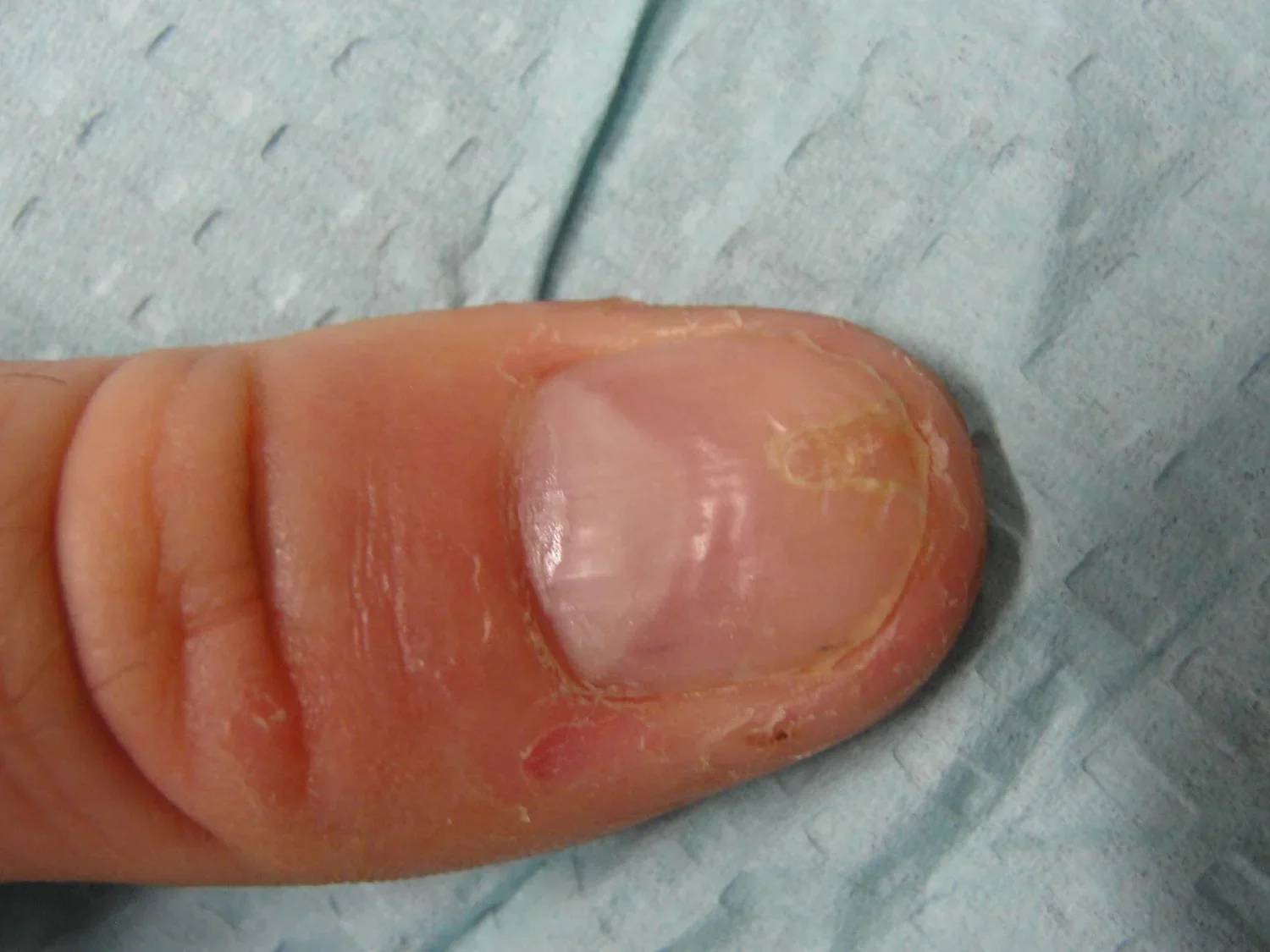 Post-treatment