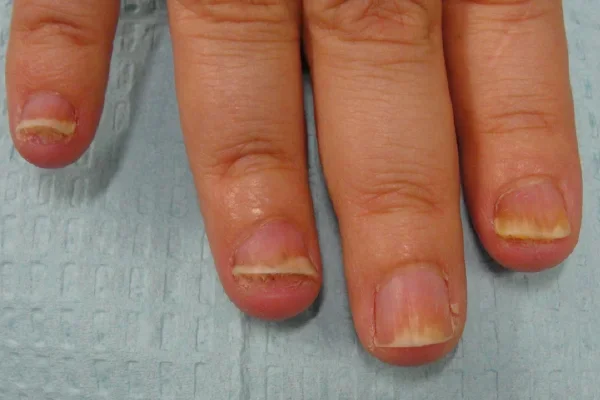Pre-treatment