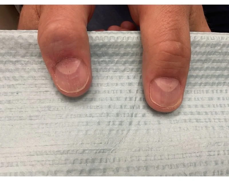 Post-treatment