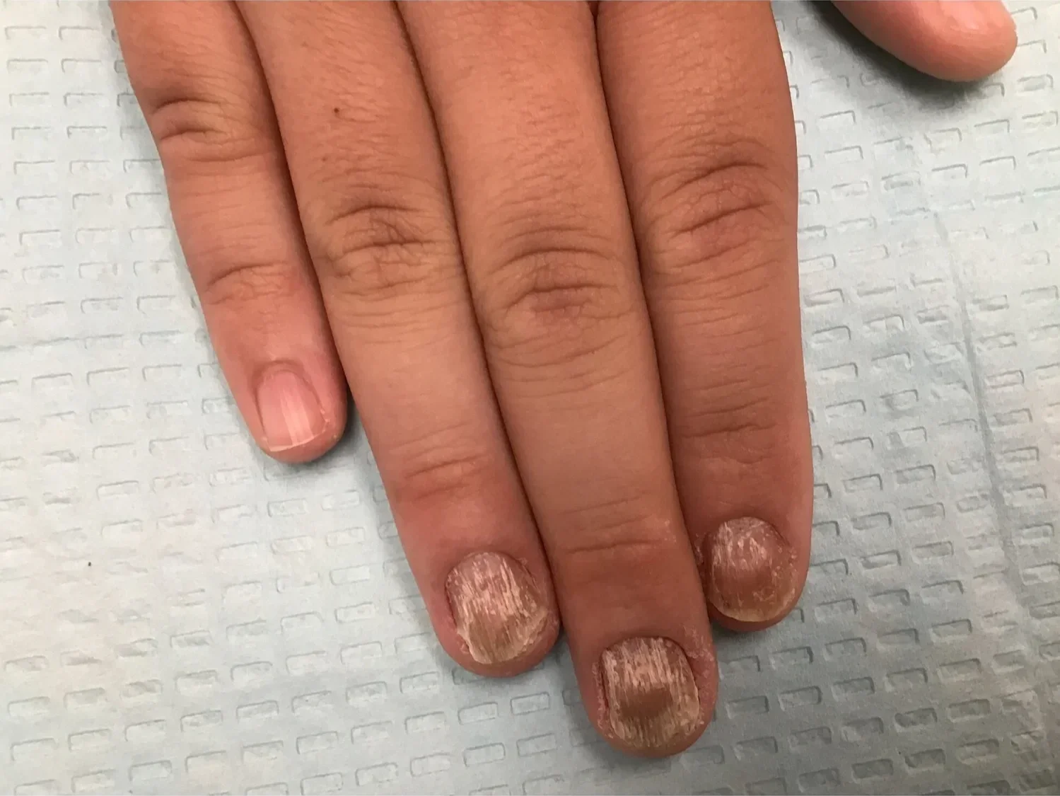 Pre-treatment