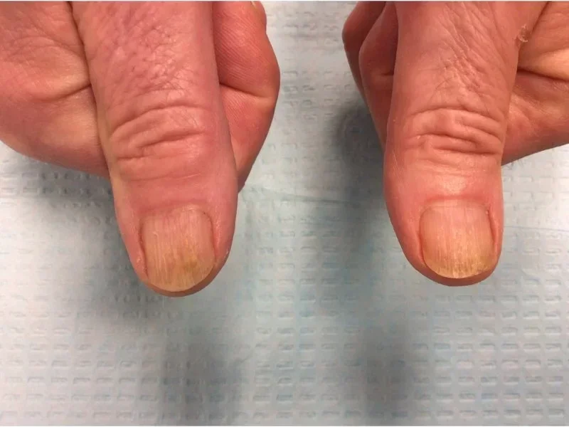 Pre-treatment