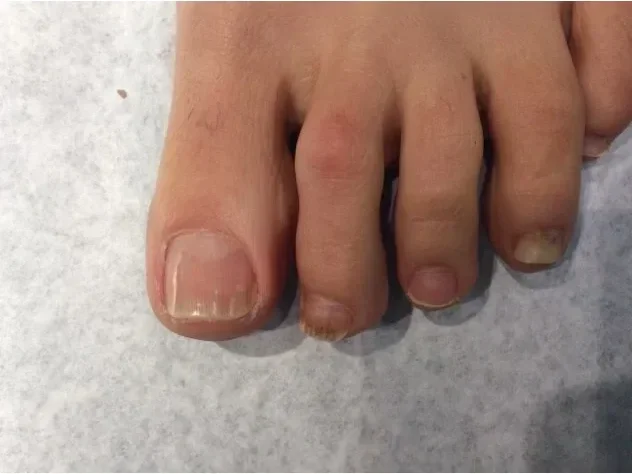Post-treatment