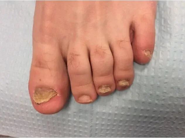 Pre-treatment