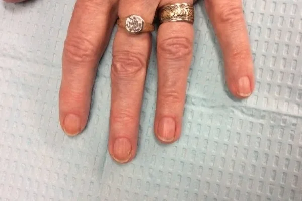 Post-treatment