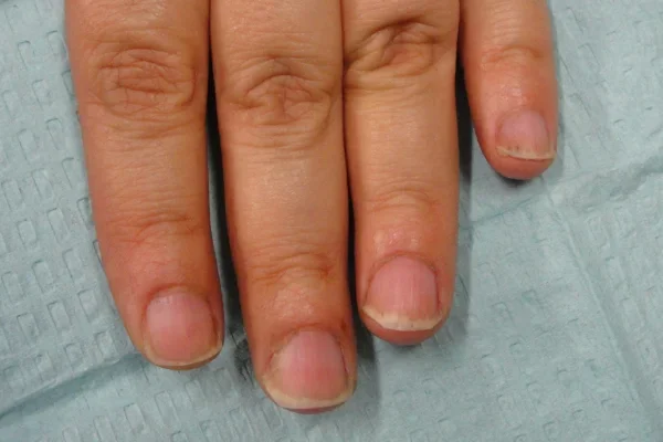 Post-treatment