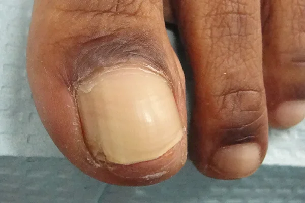 Post-treatment