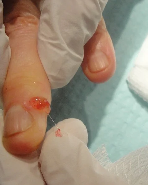 Digital Mucous Cyst Treatment