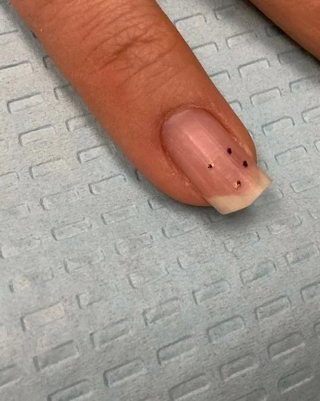 Benign Nail Tumor
