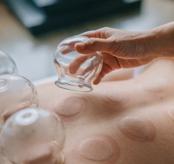 Person placing a glass cupping therapy cup on bare skin with several cups already in place.