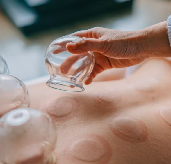 Person placing a glass cupping therapy cup on someone's bare back.
