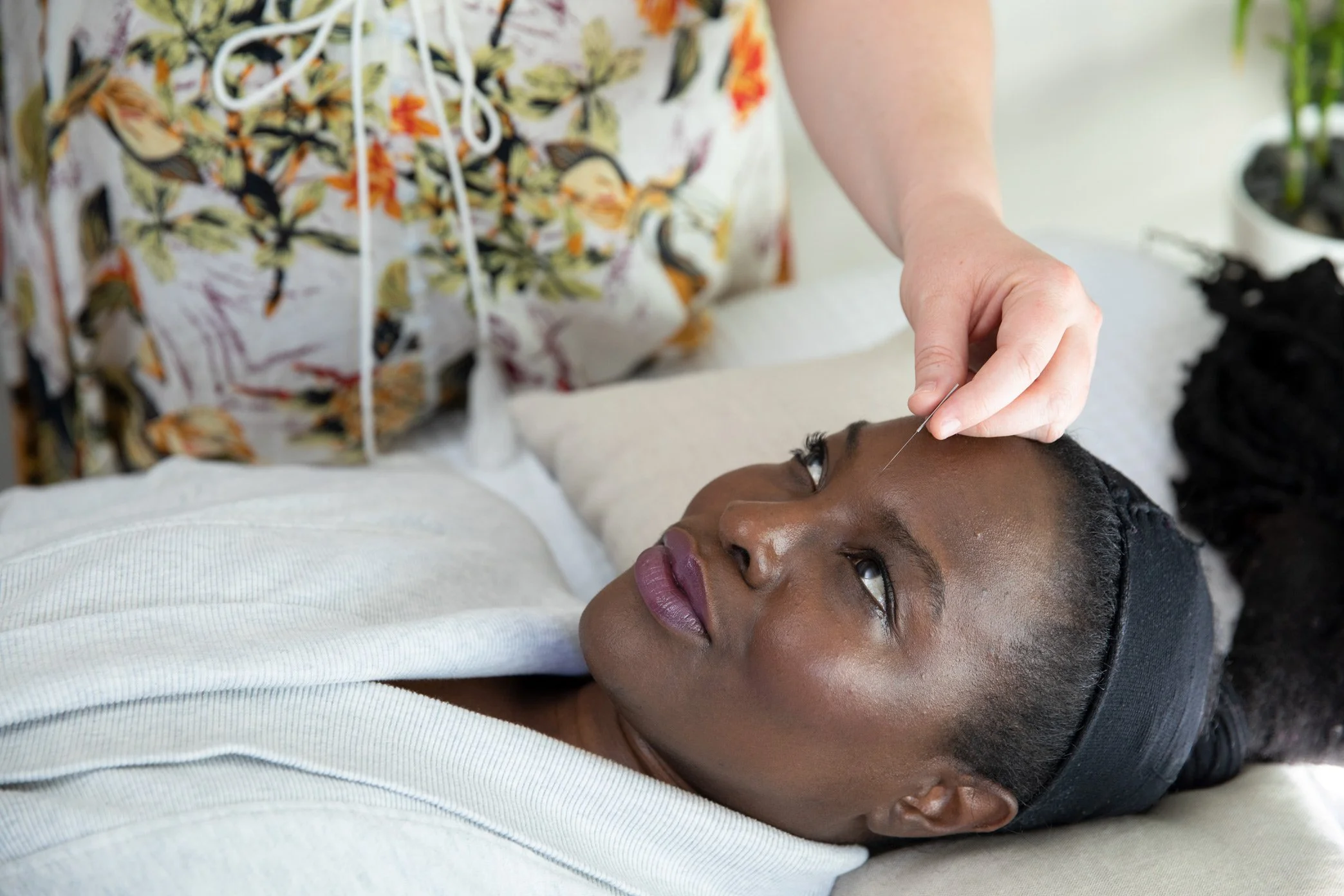 A woman receiving acupuncture treatment on her face while lying down on a bed, with a practitioner inserting a thin acupuncture needle into her forehead.