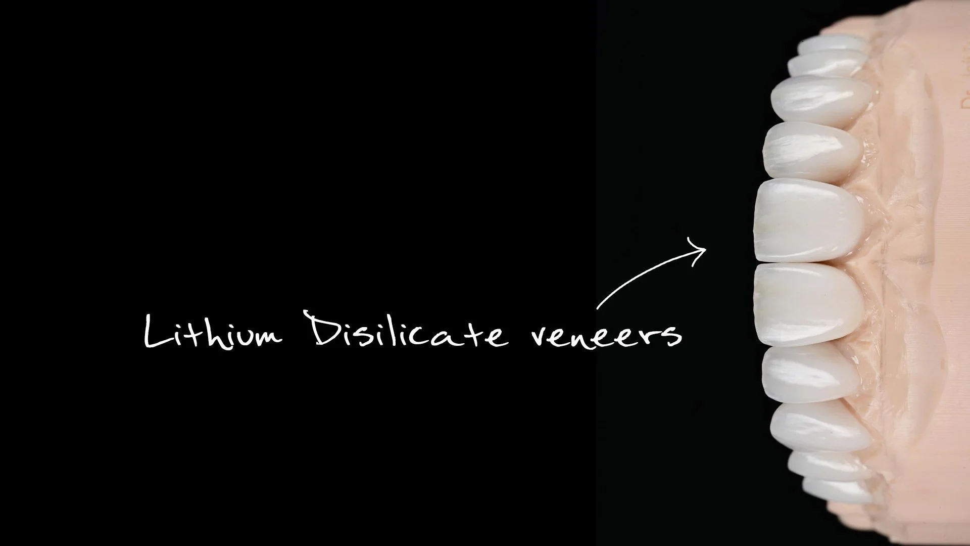 Close-up view of a dental model with white lithium disilicate veneers on the front teeth, with the text 'Lithium Disilicate veneers' and an arrow pointing to the veneers.
