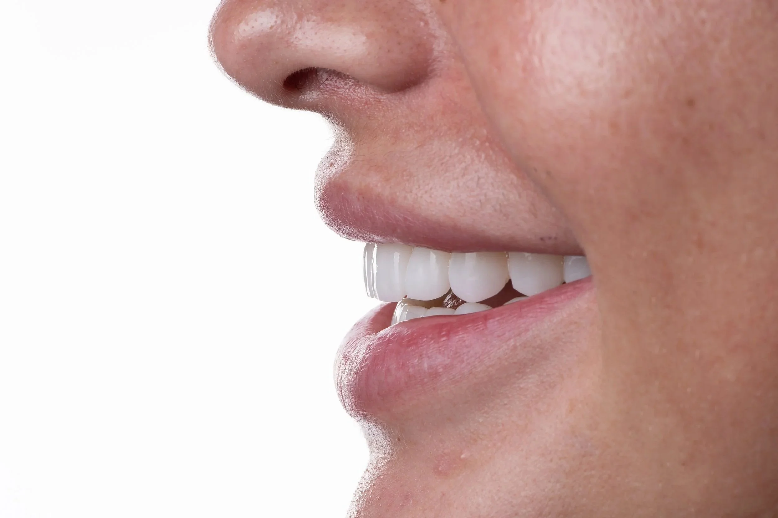 perl veneers white background by Dr. Jeff Trembley