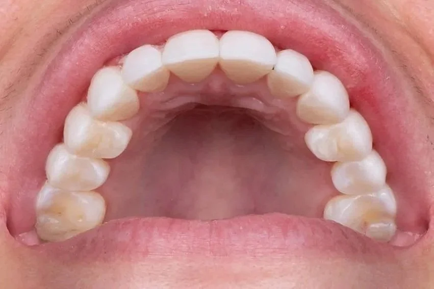 occlusal view of no-prep perl veneers