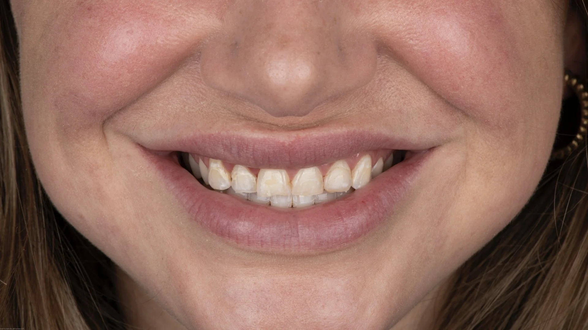 Close-up of a woman's smiling mouth showing her teeth, with some visible discoloration and unevenness.