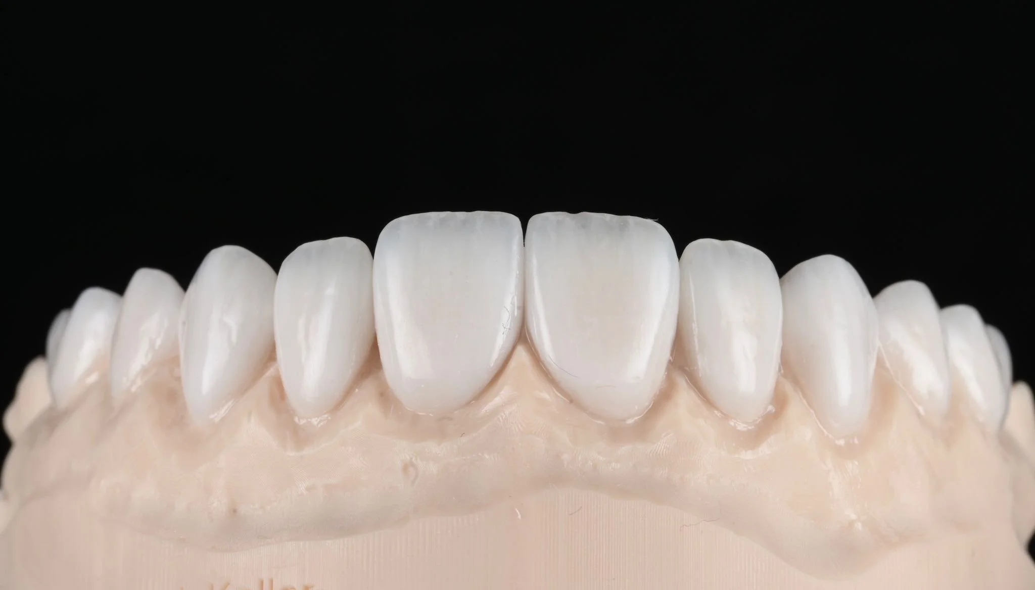 Porcelain veneers on the model by Dr. Jeff Trembley at Smile On Nashville
