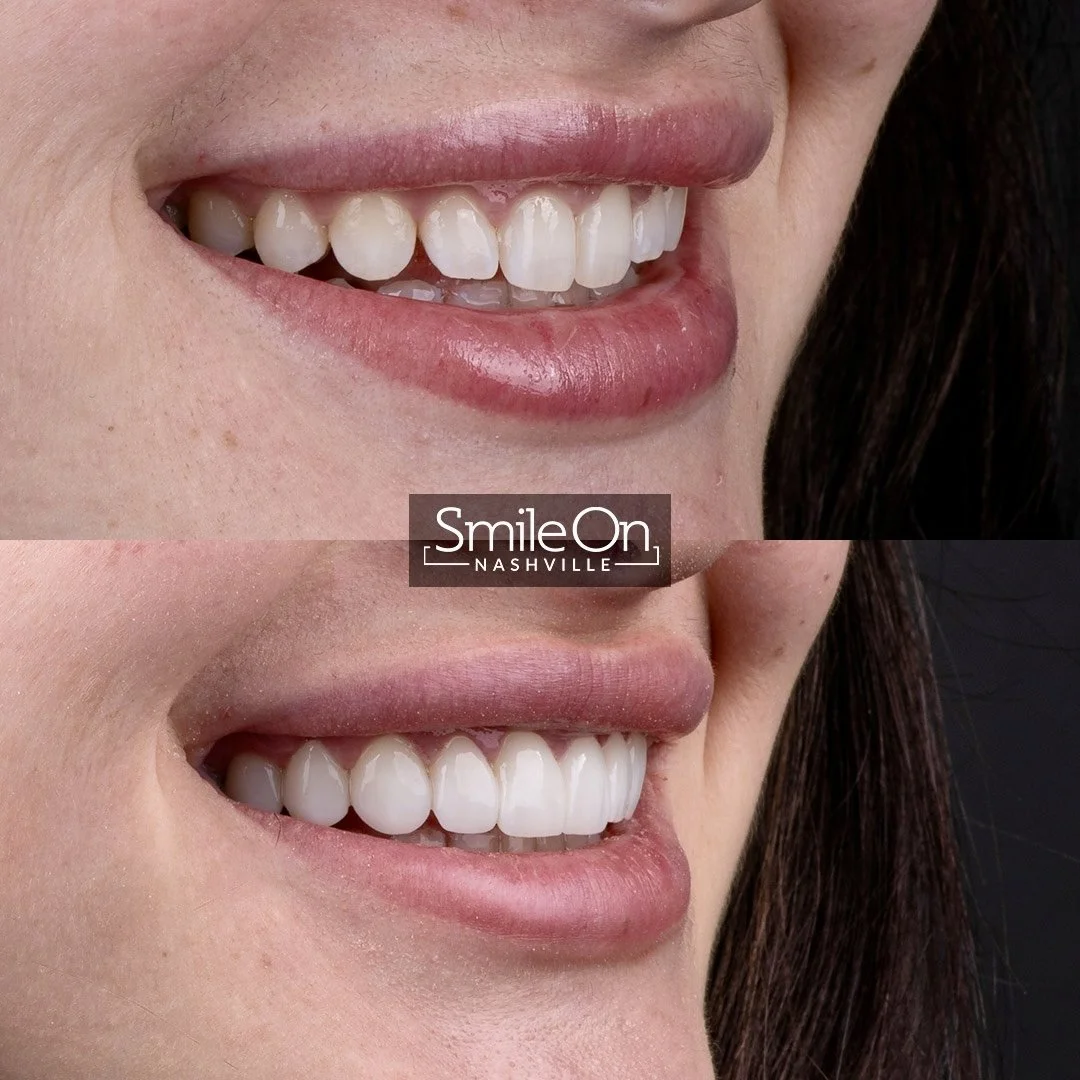 Before and after images of a person's smile showing improved teeth whitening