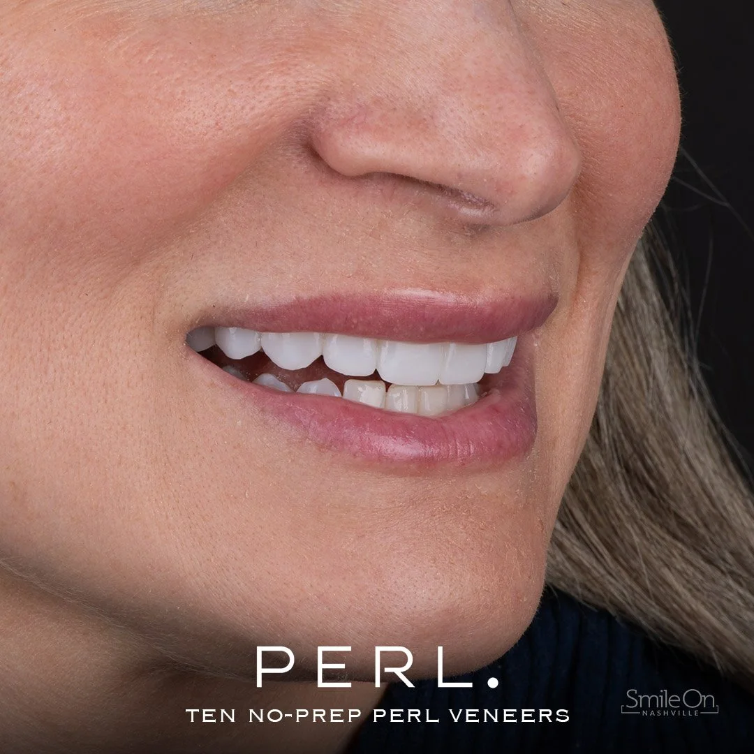 Close-up of a woman's smile showing bright, white teeth and pink lips, with text overlay "PERL. TEN NO-PREP PERL VENEERS" and a small logo "SmileOn Nashville" in the bottom right corner.