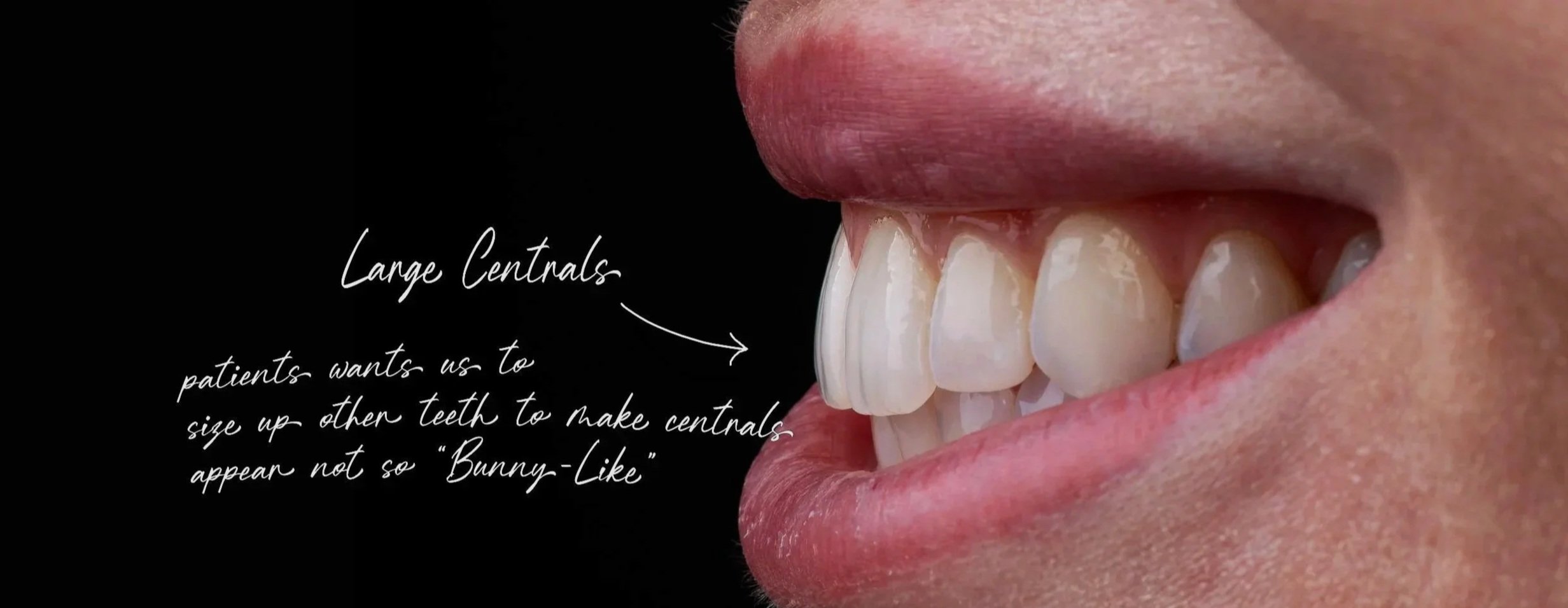 Close-up of a person smiling with visible large central teeth, accompanied by text explaining dental aesthetics and the appearance of large central incisors.