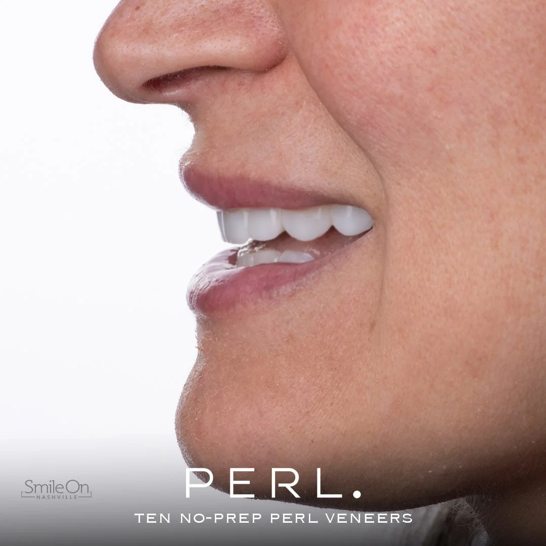 Close-up of a woman's side face showing her lips and teeth, promoting PEL Ten No-Prep Pearl Veneers.