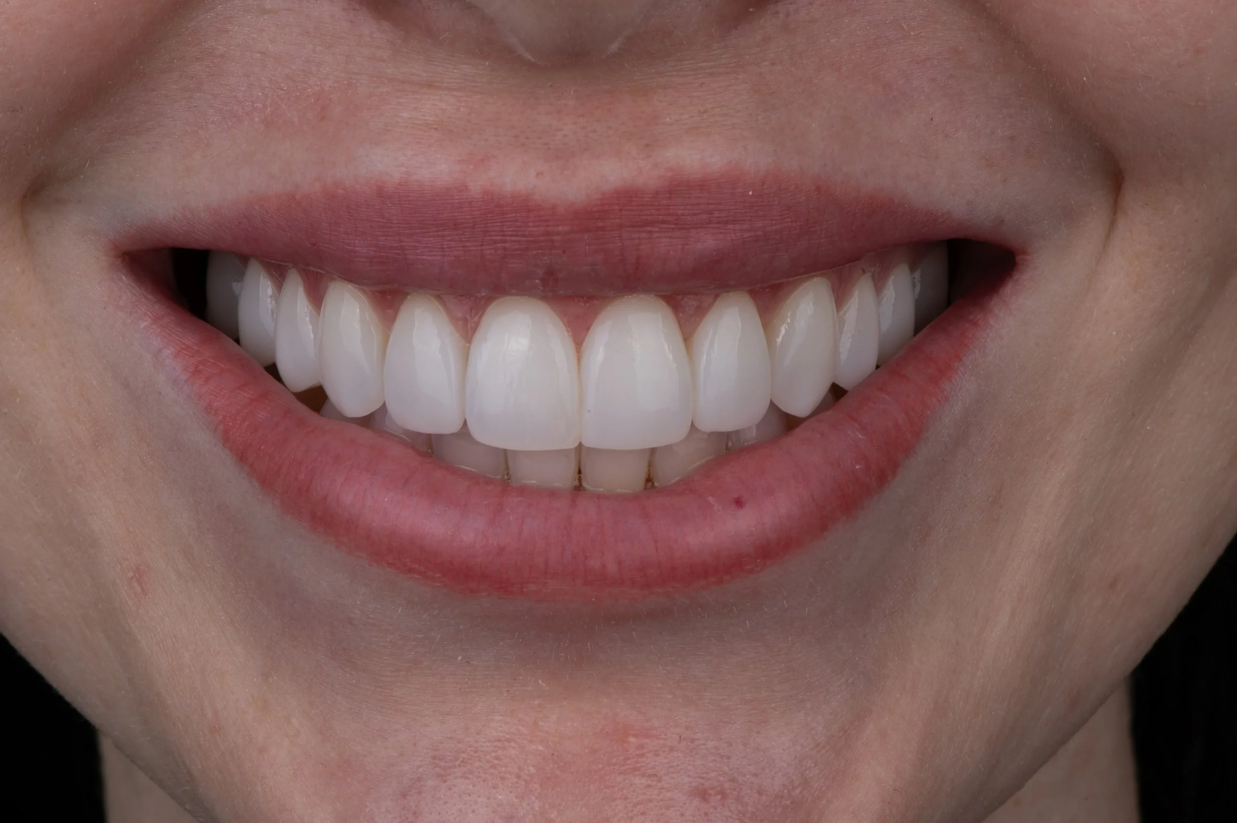 PERL veneers