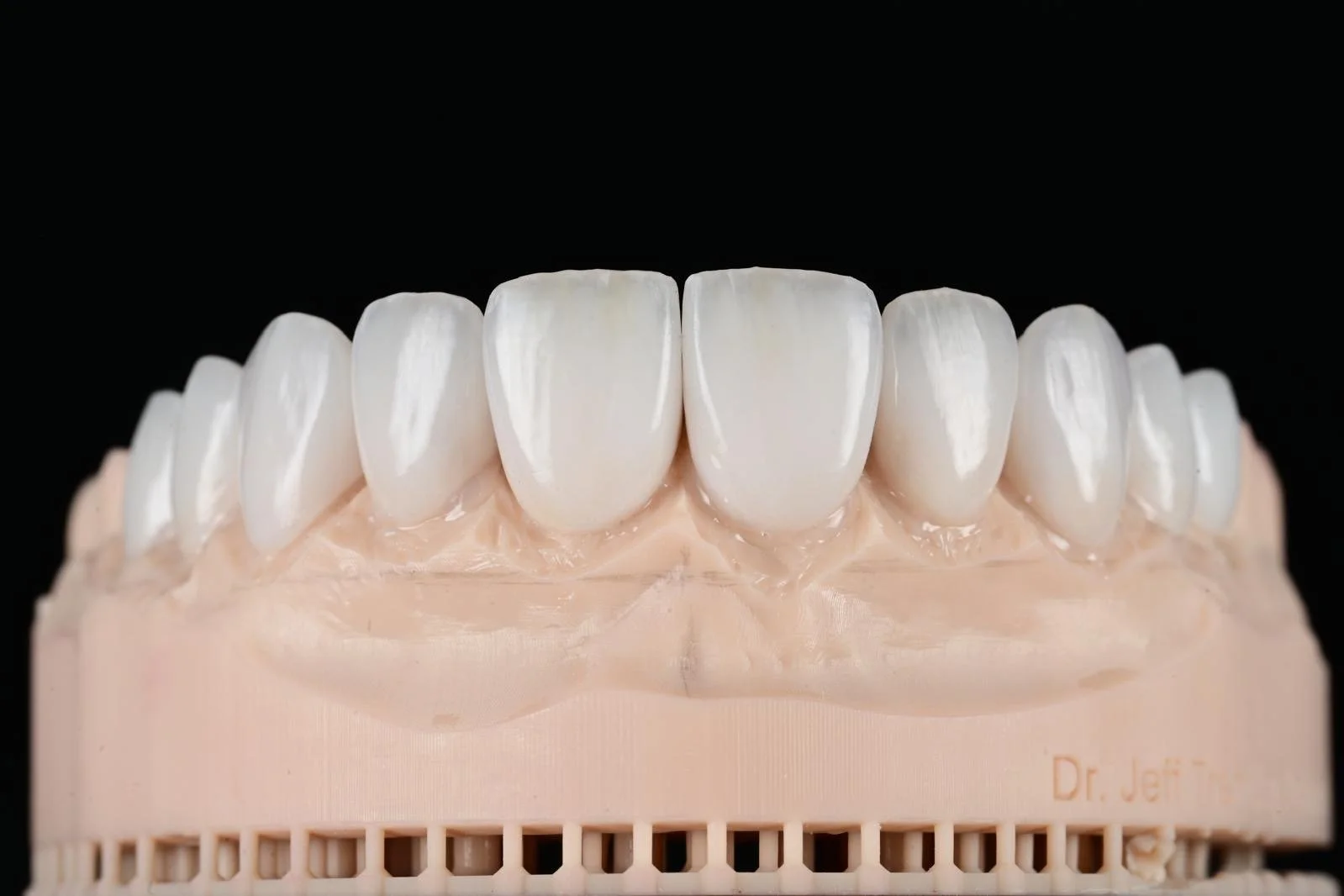 Dental model showing upper teeth with natural appearance on a stand.