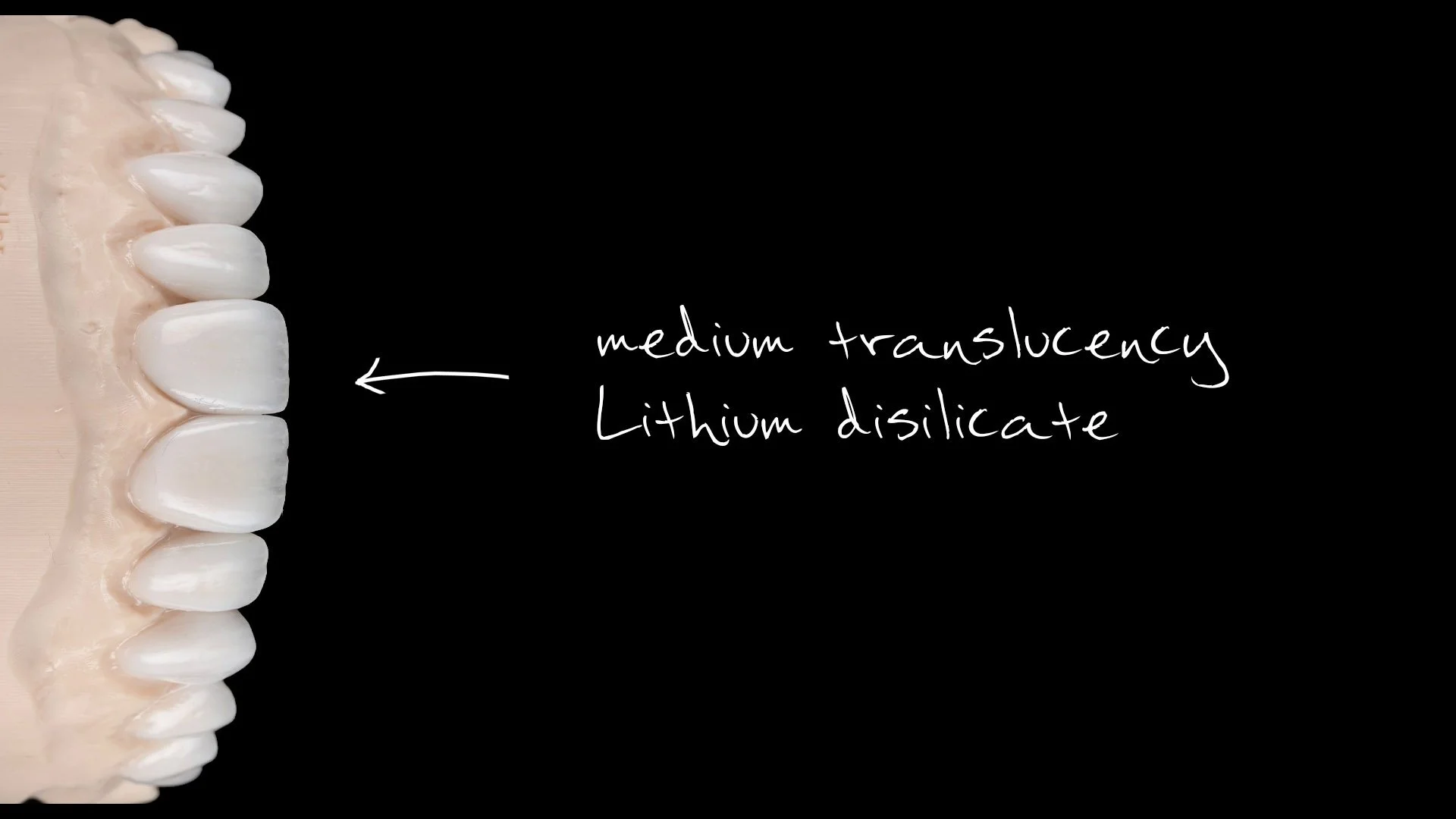 Close-up of a dental model showing white teeth with a handwritten note pointing to them, indicating 'medium translucency lithium disilicate'