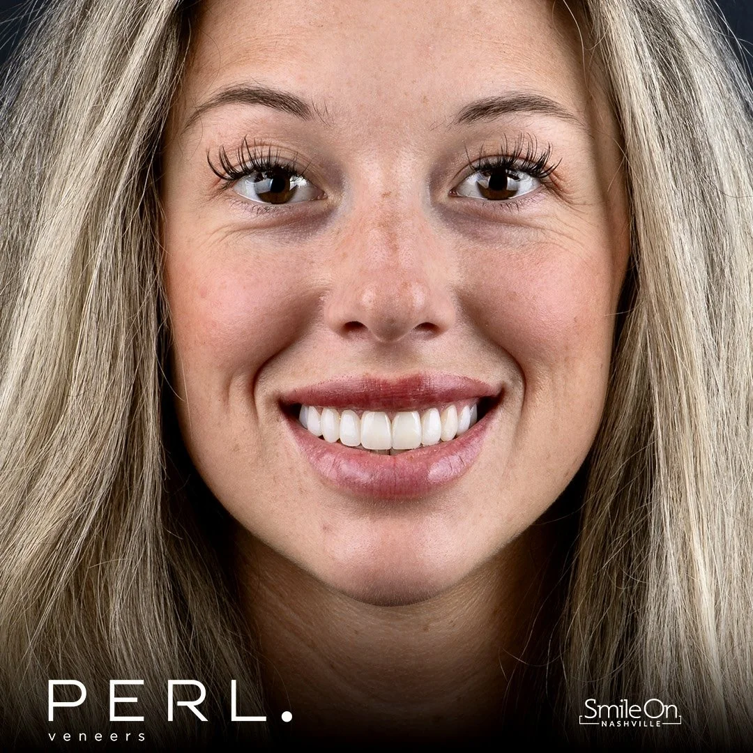 Close-up photograph of a smiling woman with long blonde hair and bright white teeth, advertising Pearl Veneers by Smile On Nashville.