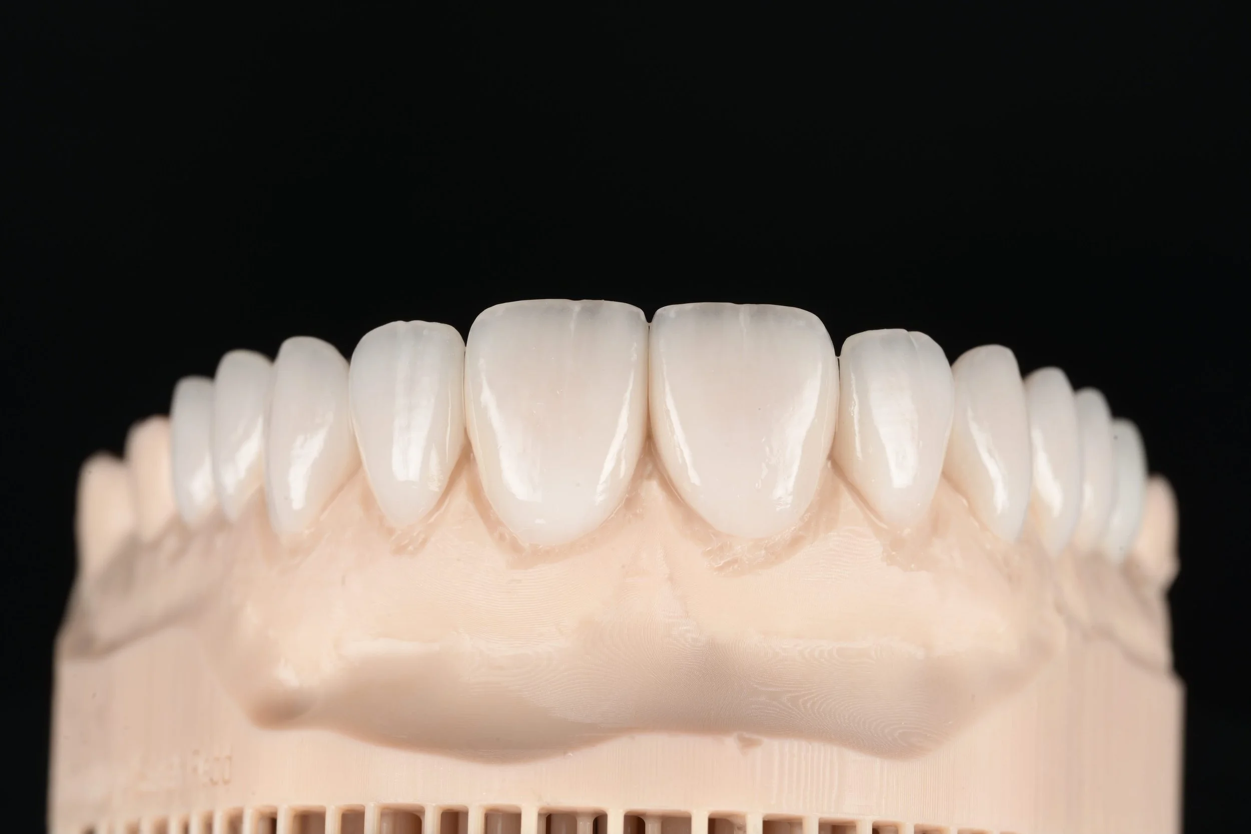 Porcelain-veneers