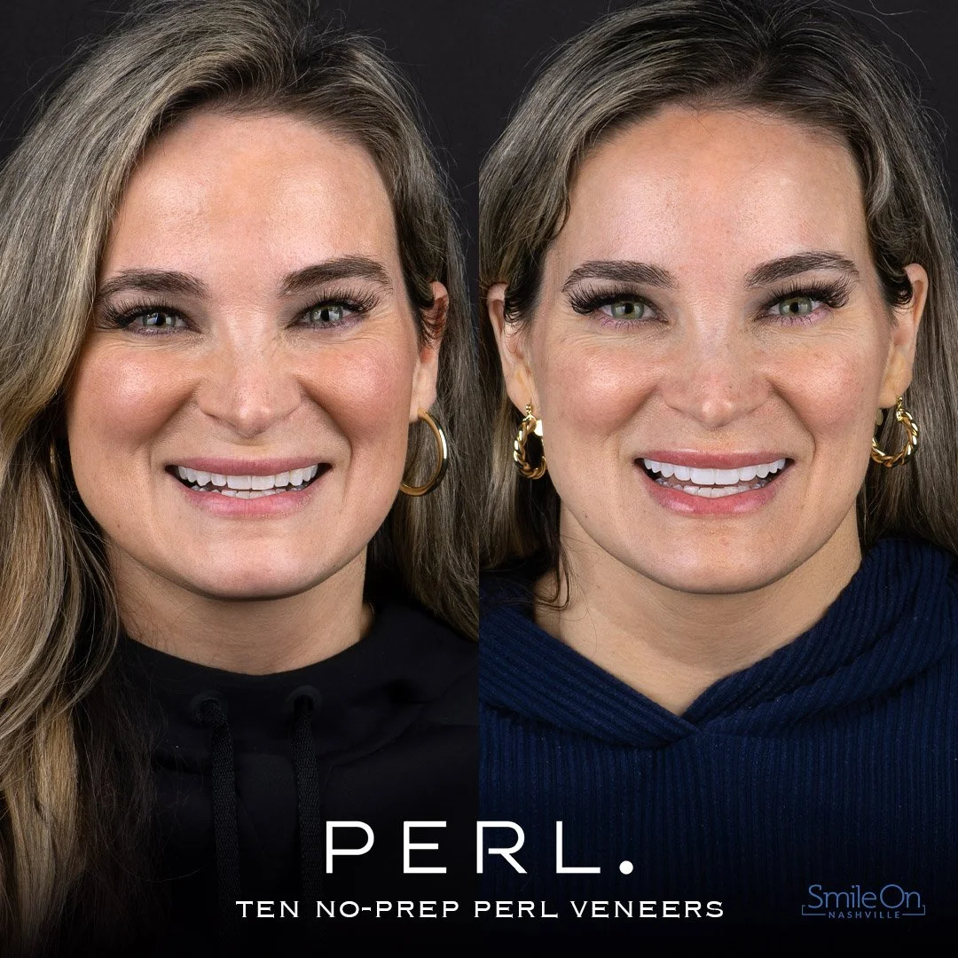 Side-by-side close-up photos of a smiling woman with long brown hair, wearing hoop earrings, with before and after images showcasing dental work, with text overlay stating 'PERL. TEN NO-PREP PERL VENEERS' and a logo for Smile On Nashville.