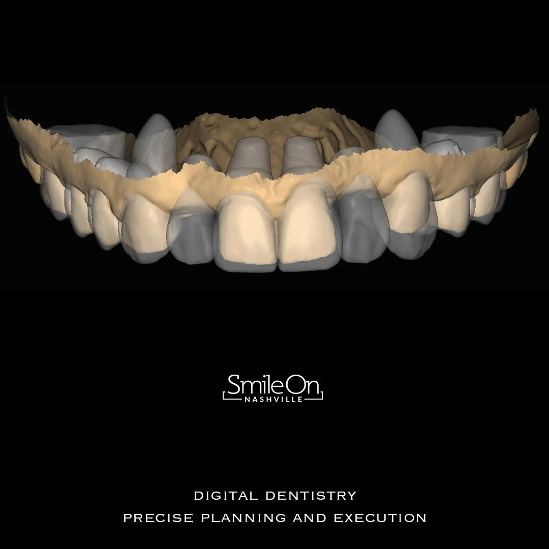 Digital rendering of a set of human upper teeth, showing dental preparation for veneers or crowns, with the gums and surrounding structures.