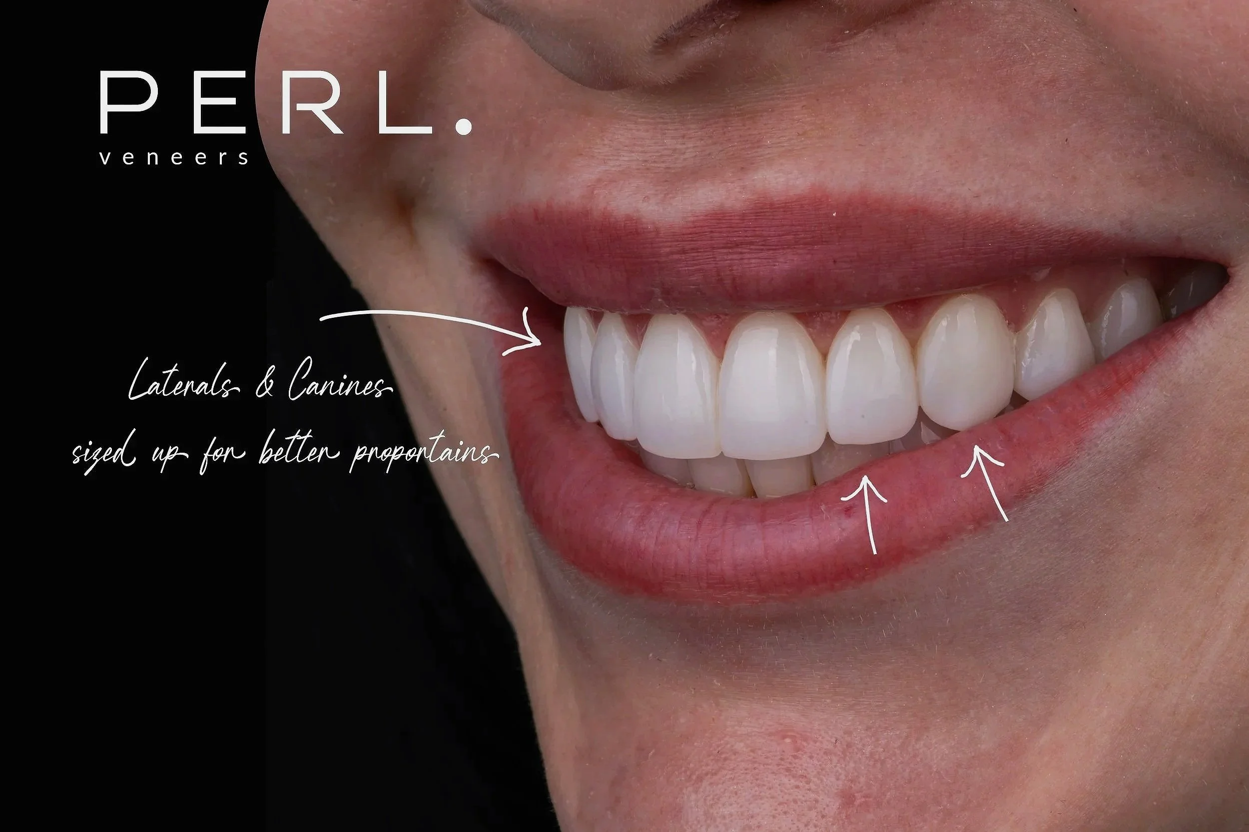 Close-up of a person's smile revealing upper front teeth, with handwritten annotations pointing to the lateral and canine teeth, and text indicating the focus on veneers sized for better proportions.
