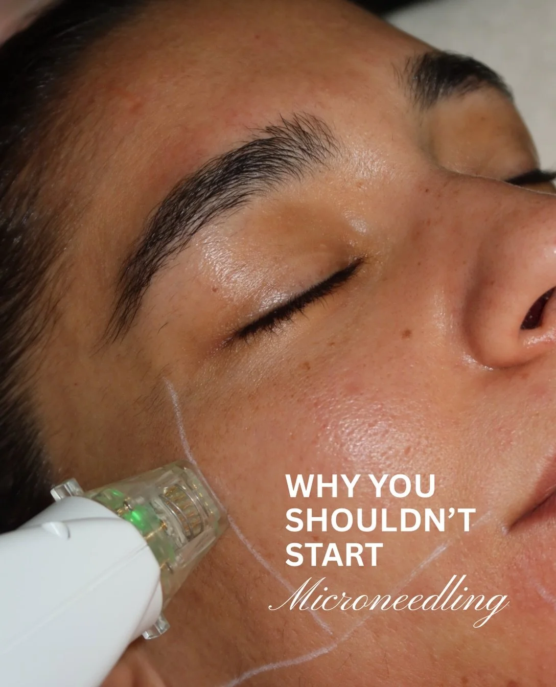 Let&rsquo;s talk about it&hellip; 

#microneedling #skin #skincare 

Clear skin is over rated&hellip;

I&rsquo;m sure staying hydrated can help with scarring it just might take a fair few years&hellip;

I mean who wants to be told they look 20 in the