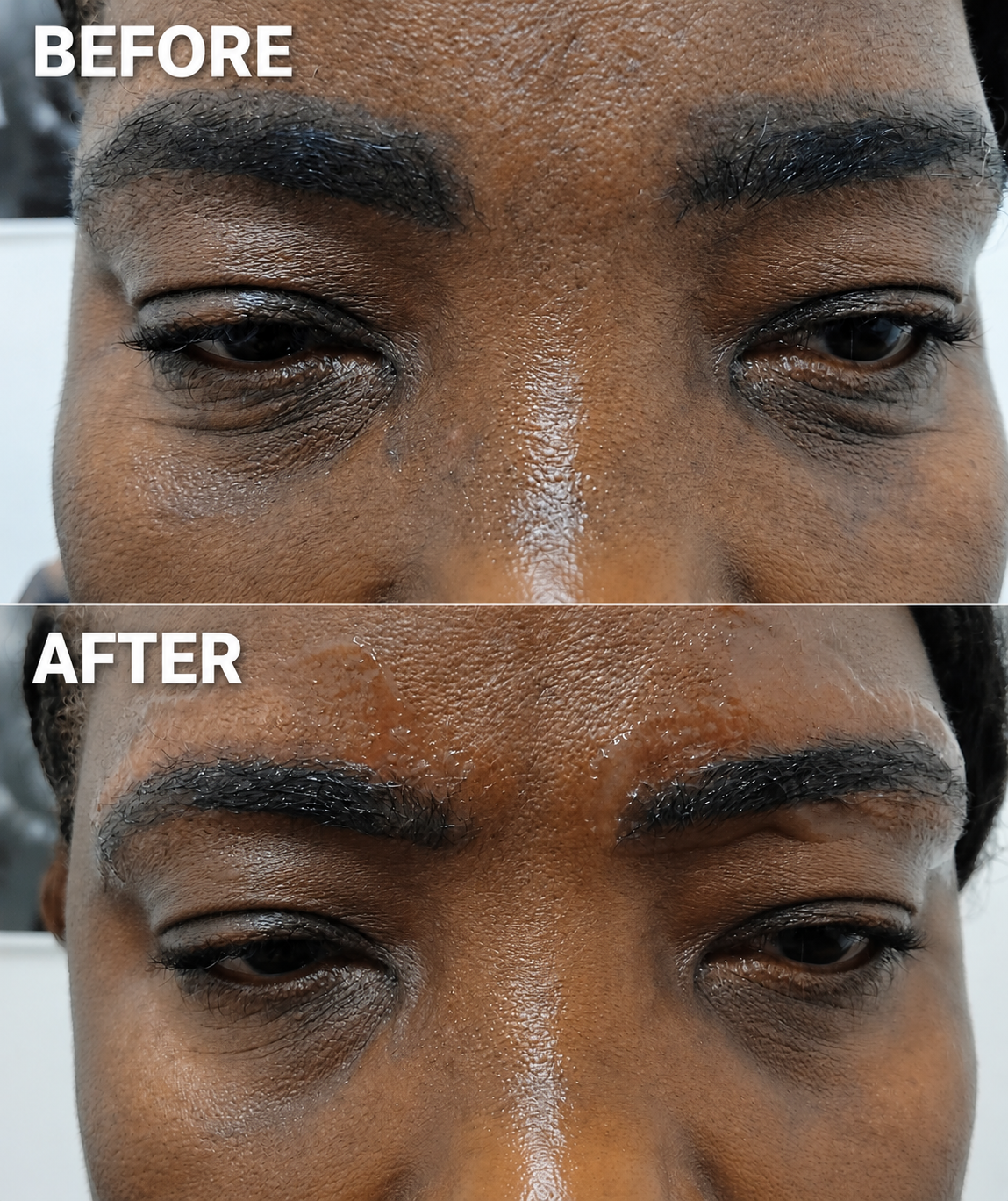 Close-up comparison of a person's eyebrows and eye area before and after a treatment. The 'before' image shows thicker, darker eyebrows and puffiness around the eyes. The 'after' image shows neater eyebrows and reduced puffiness, with smoother skin t
