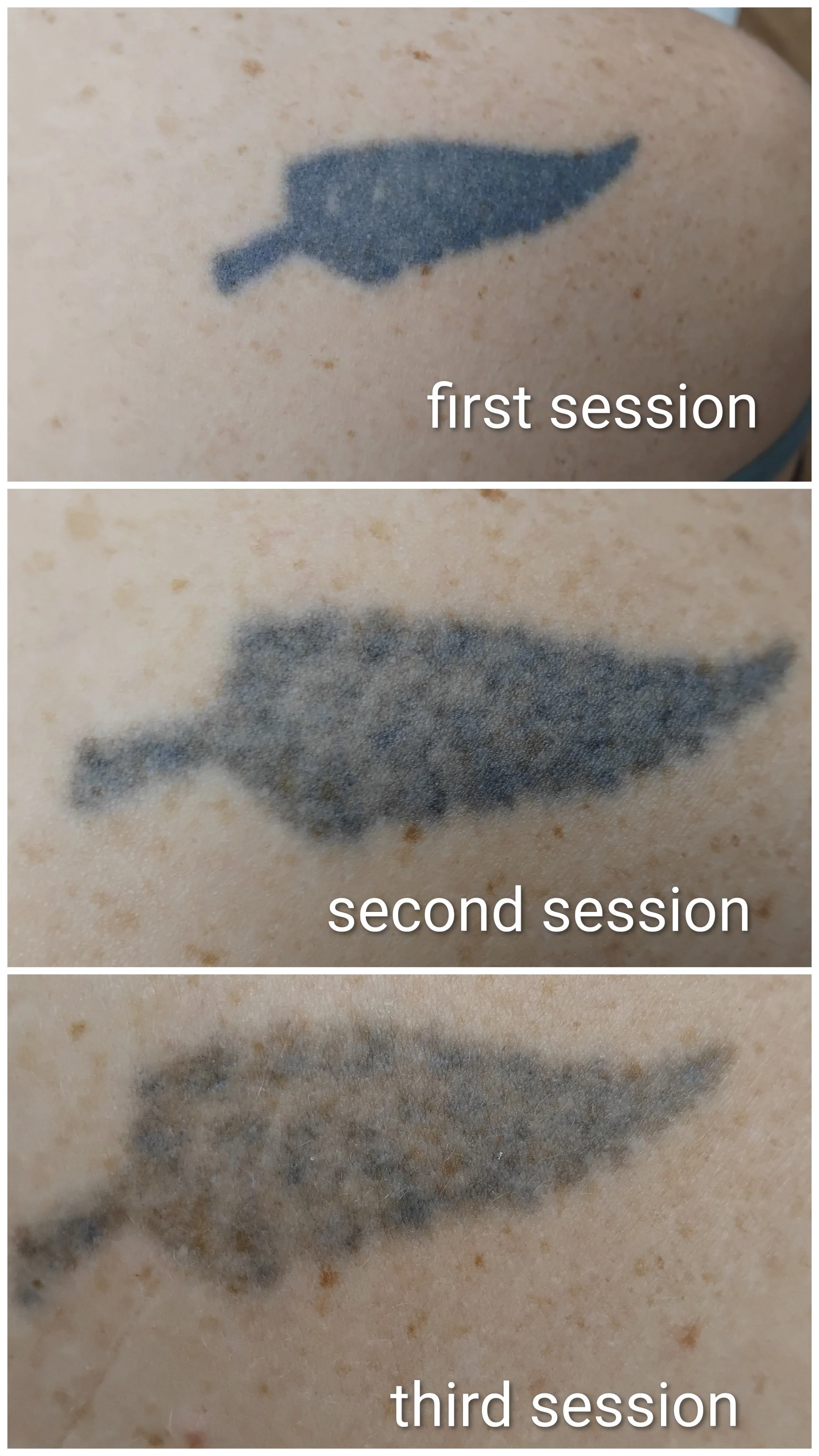 Great fade - laser tattoo removal brisbane