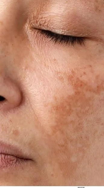 Close-up of a person's face showing skin with freckles and pigmentation.