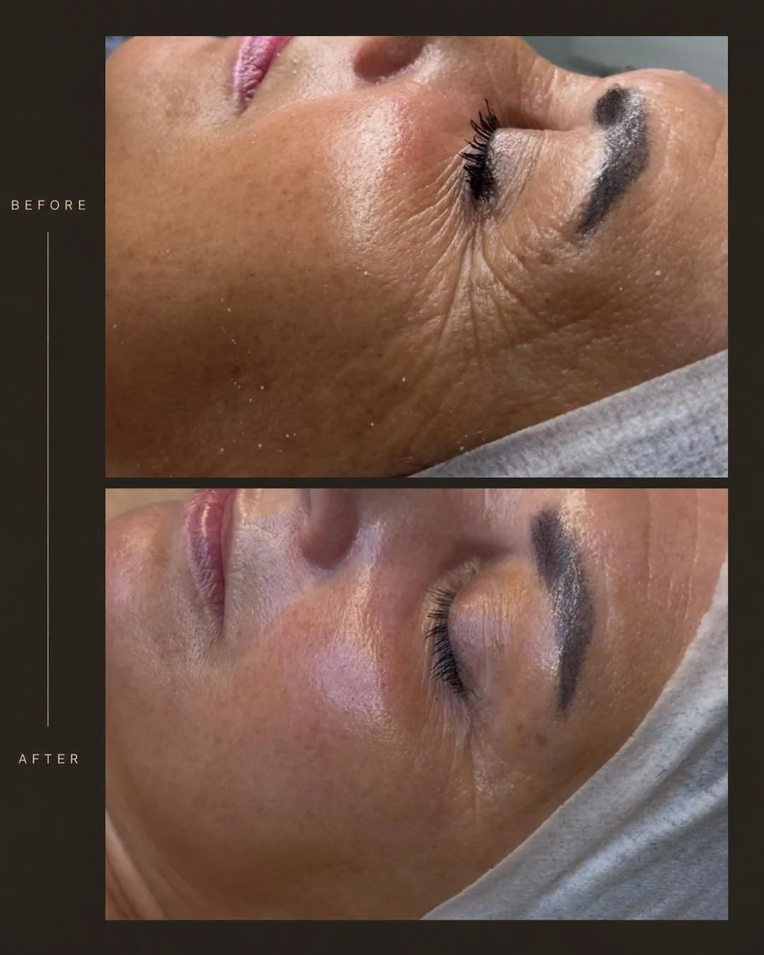 Results worth waiting for.

Every skin journey is unique. Our focus is on supporting long term skin health with treatments tailored to your individual needs and goals.

For this client, we combined coco Enzyme + firming peptide treatment to support a