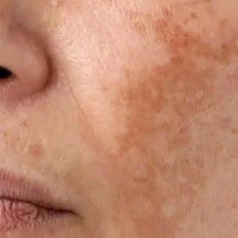 Close-up of a person's face showing freckles and skin texture.