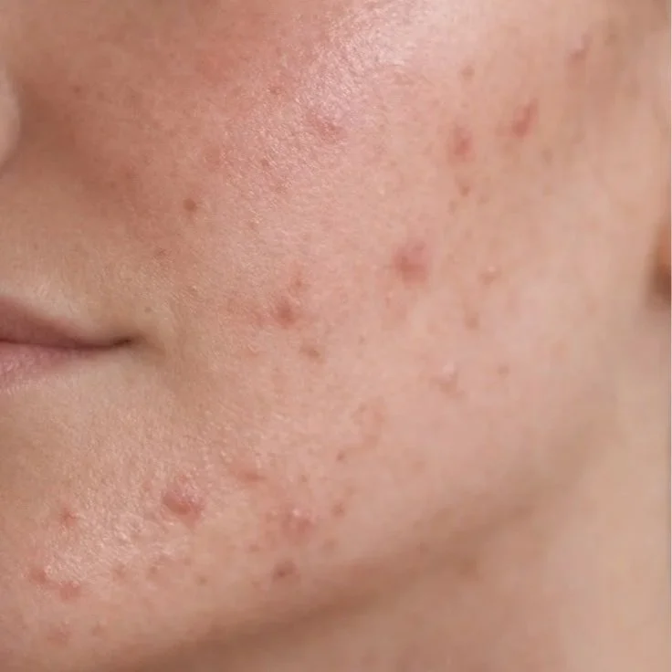 Close-up of a person's cheek with acne and pimples.