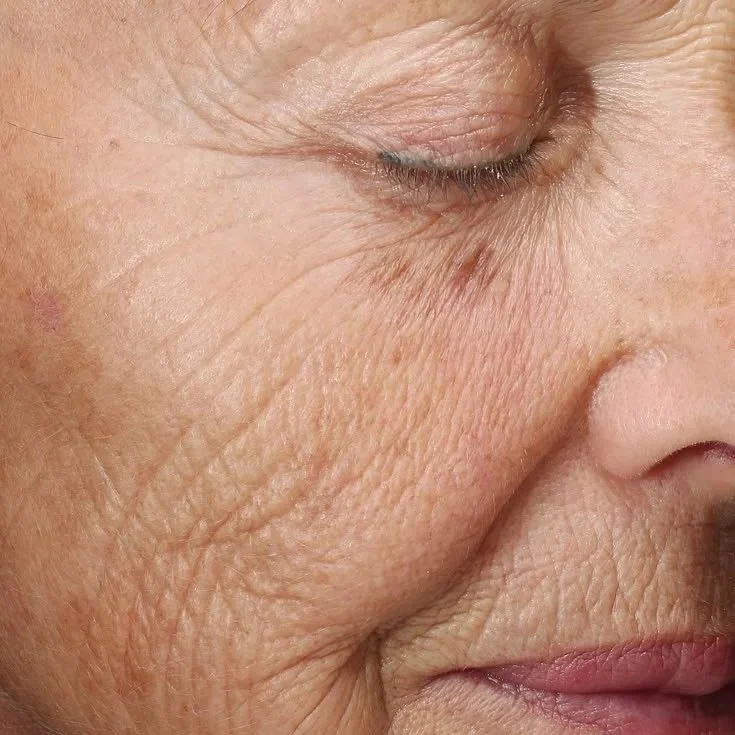Close-up of a person's aging face showing wrinkles around the eye, cheek, and mouth areas.