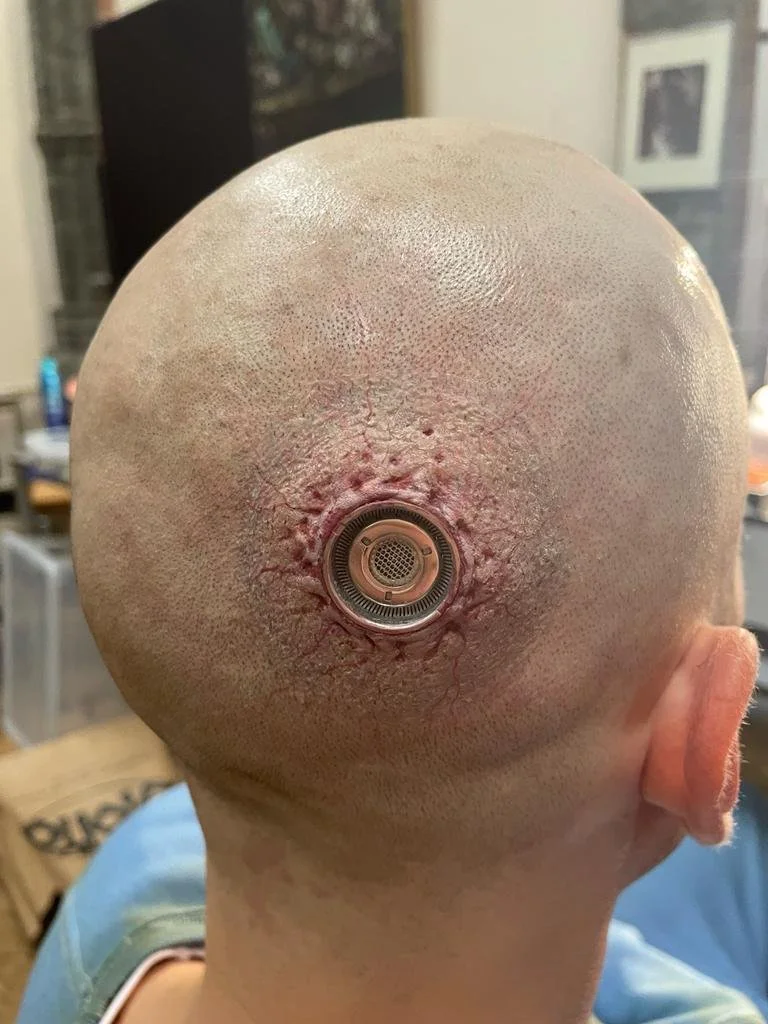 Close-up of a person's scalp with a shaved head, showing a circular surgical wound with stitches and a medical device implanted in the center.