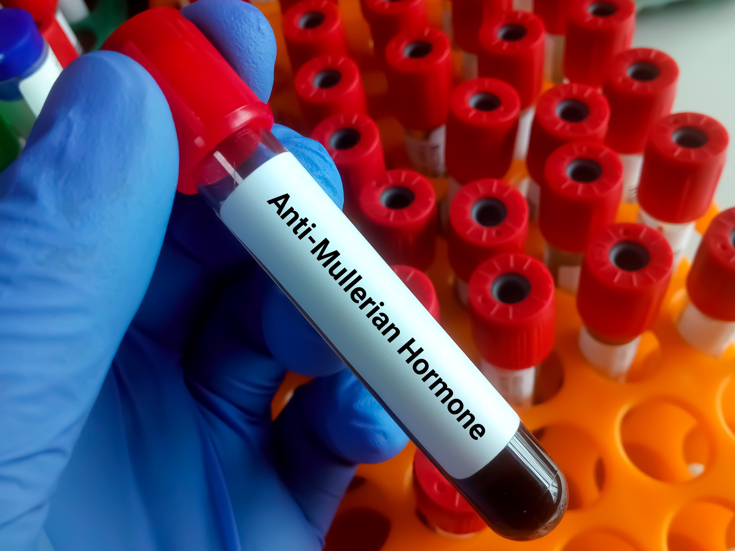 Ovulation Count AMH Test: What Your Results Mean | Life Fertility Sydney — Life ...