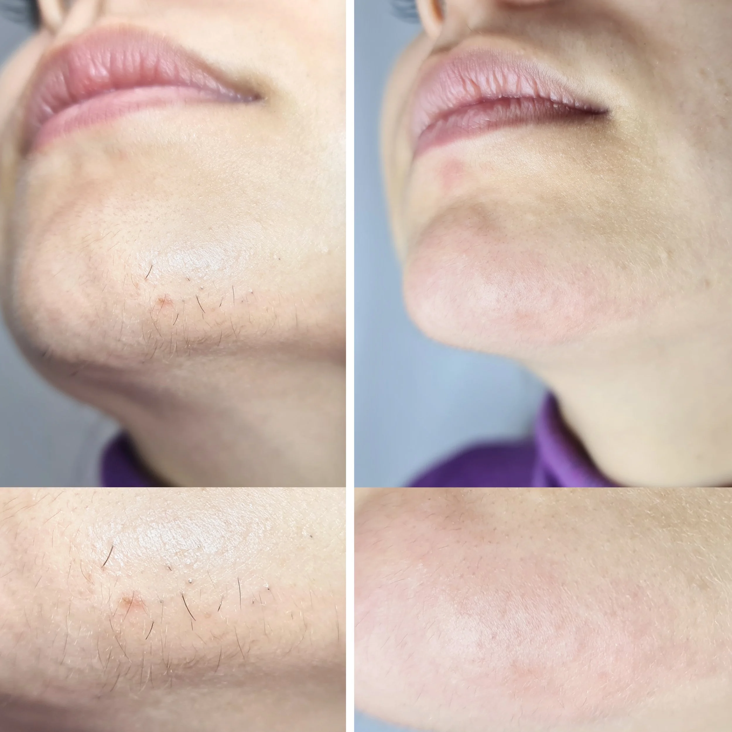 Comparison of lips and surrounding skin before and after cosmetic procedure, showing improved smoothness and reduced imperfections in the after image.