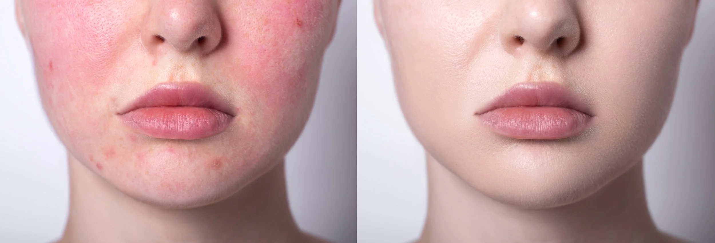 Comparison of a woman's face before and after skincare treatment, showing clearer, smoother skin with reduced redness and acne.