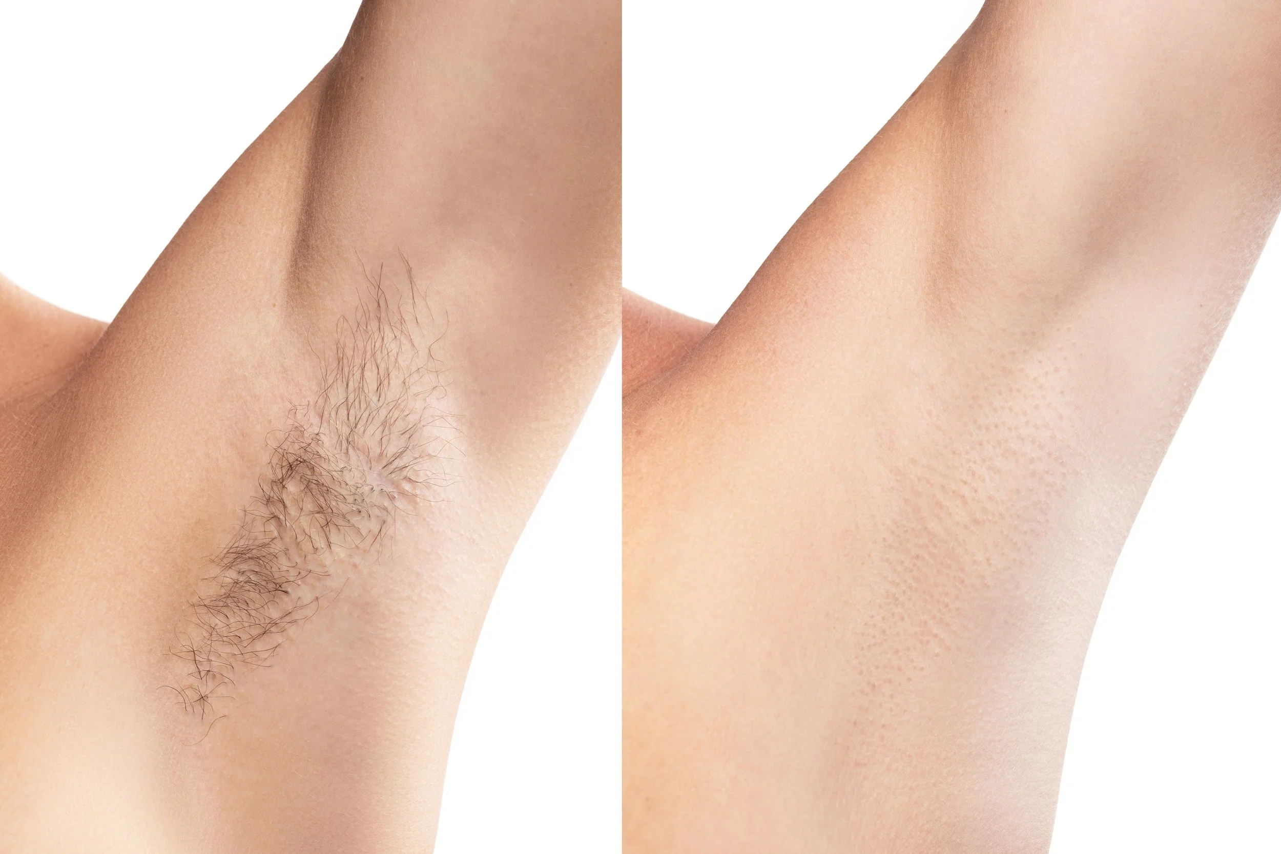 Laser Hair Removal