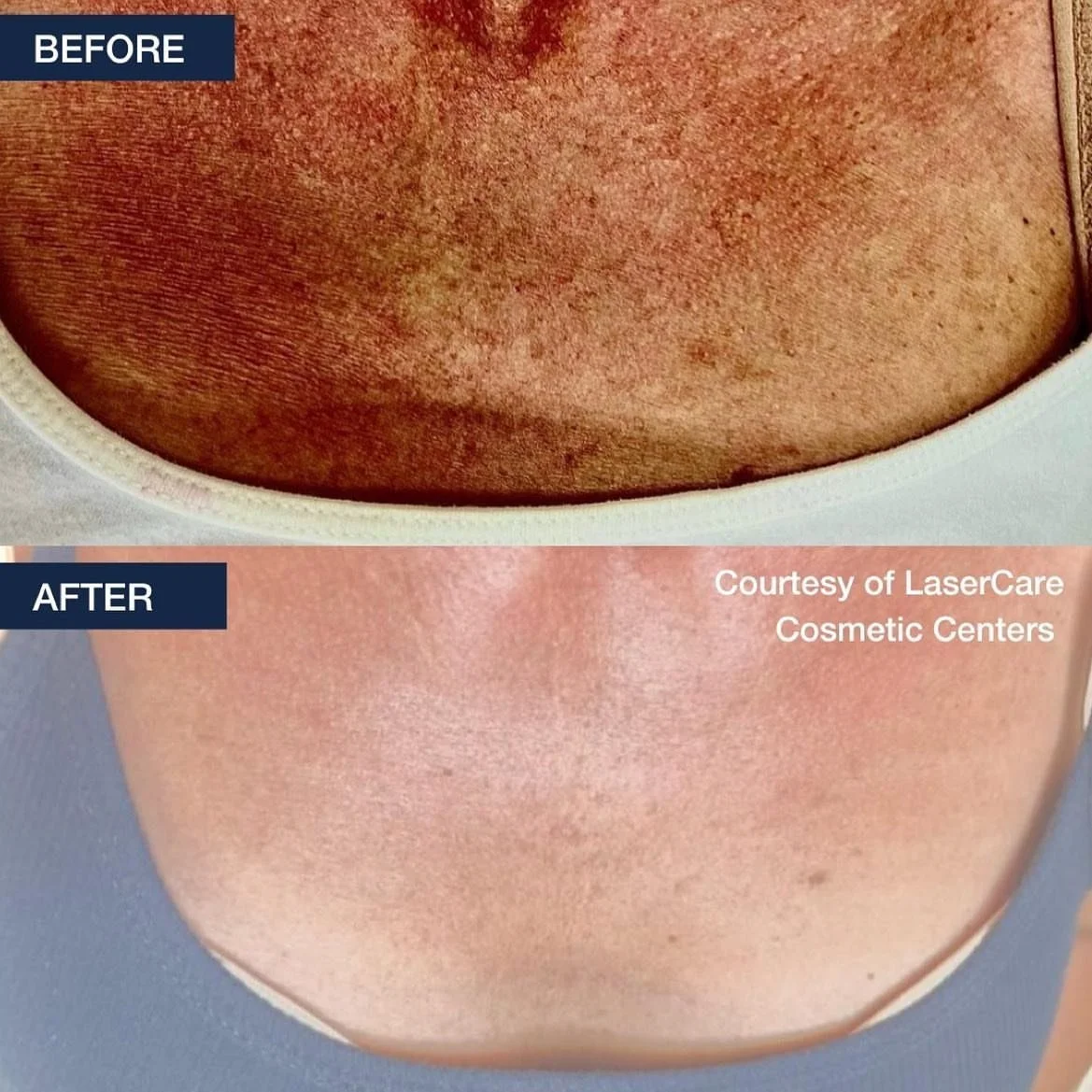IPL Photofacials