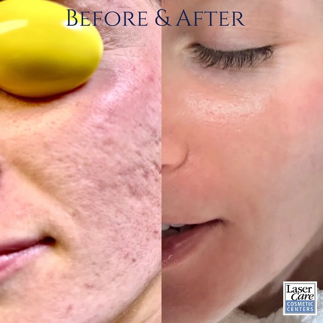 Skin Rejuvenation