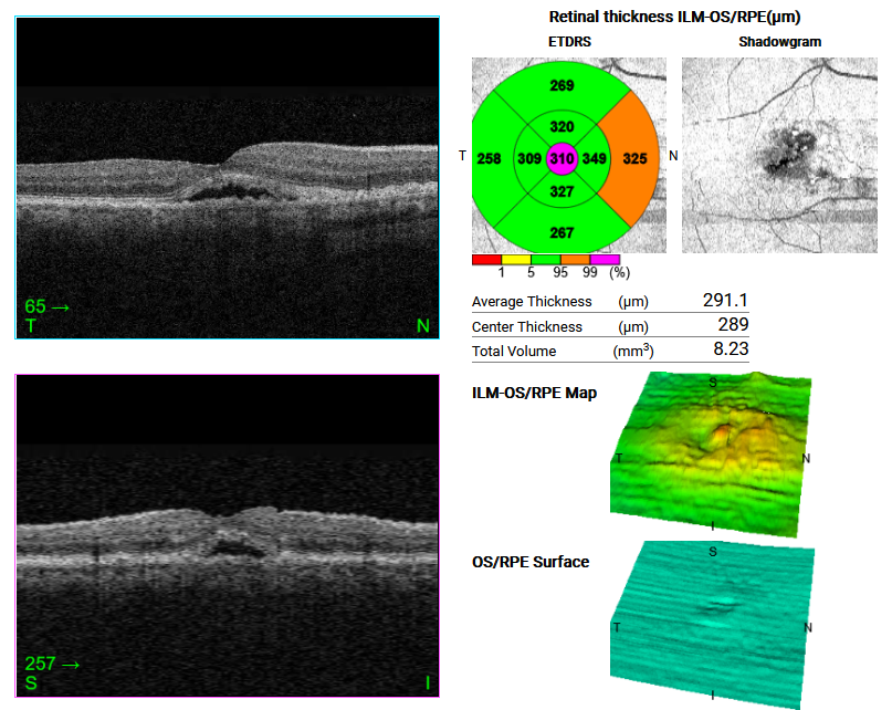 An OCT scan of vitelliform dystrophy, a rare form of degeneration at the macula.
