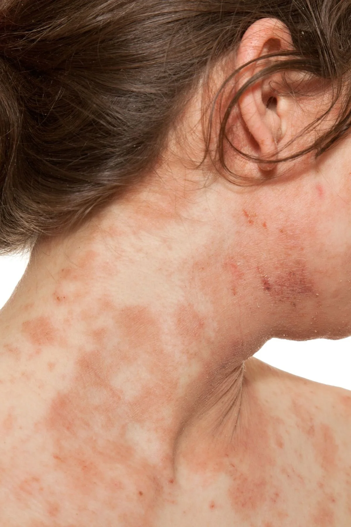 Close-up of a person's neck and face showing red, inflamed skin with rashes and irritation.